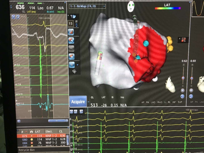 標(biāo)測電極精準(zhǔn)顯示M電位，即消融靶點