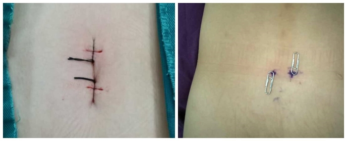 微創(chuàng)手術切口